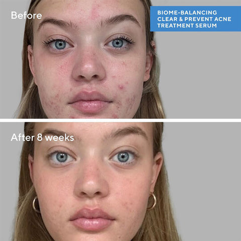 Biome-Balancing Clear & Prevent Acne Treatment Serum